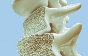 Osteoporose of botontkalking